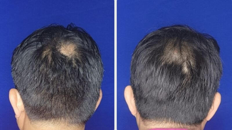 Lorenzo před a po 150 dnech používání Bio-Pilixin
