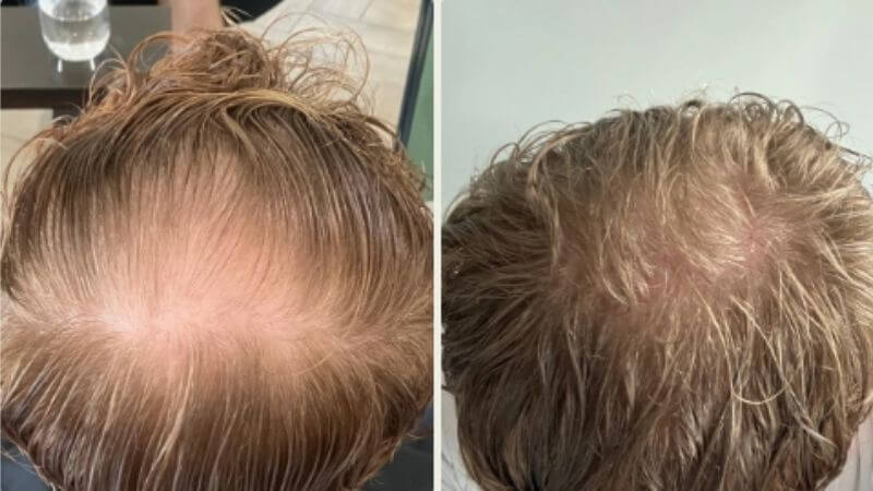 Sean – zákaznické fotografie před a po používání Bio-Pilixin