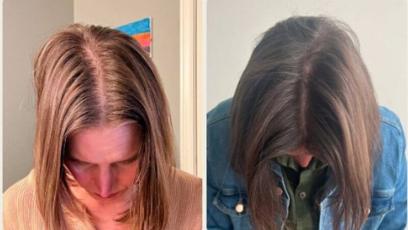 Shannon před zahájením a po 150 dnech používání Bio-Pilixin Hairline Boosteru