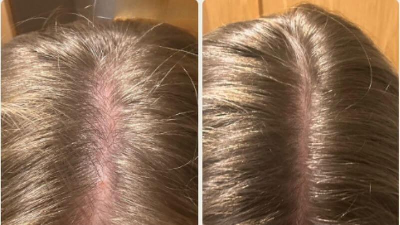 Tetiana – pěšinka a pokožka hlavy před a po používání produktů Scandinavian Biolabs