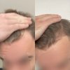 Bio Pilixin Hairline Results