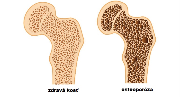 osteoporosis