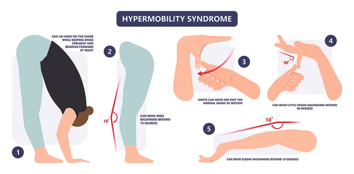 Hypermobilita: proč velký rozsah nestačí bez síly a stability