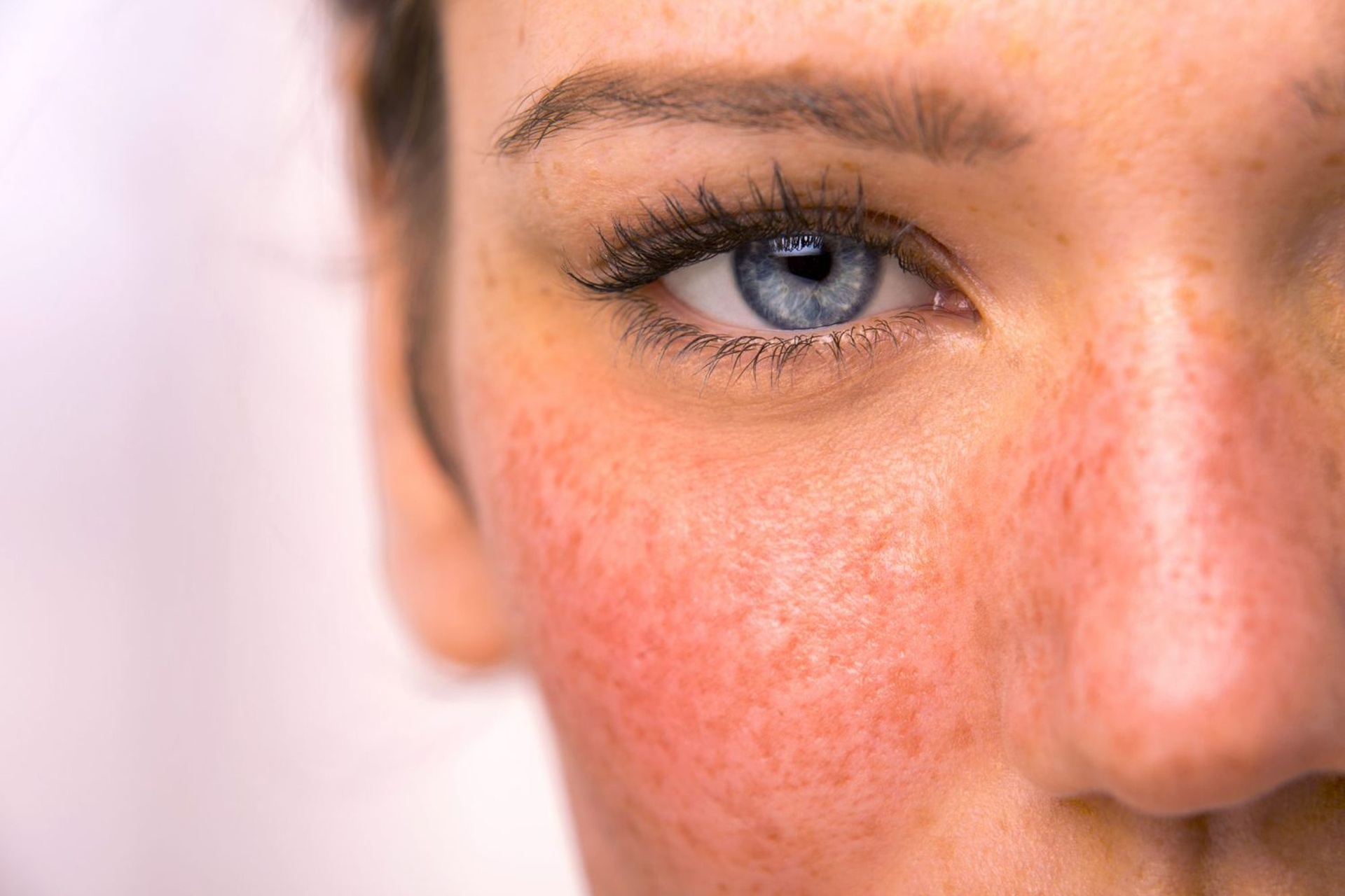 rosacea