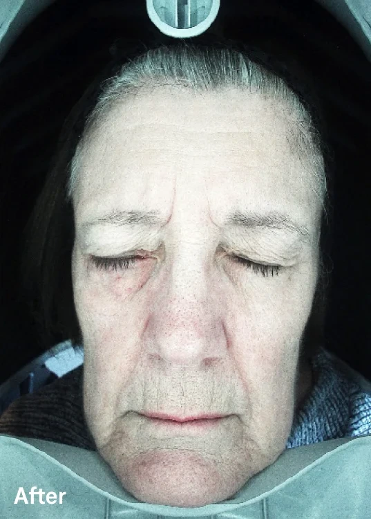Omnilux Contour Face – klinická fotografie po použití, čelní pohled