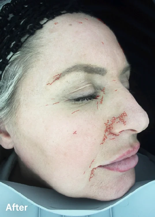 Omnilux Contour Face – klinická fotografie po použití, boční pohled