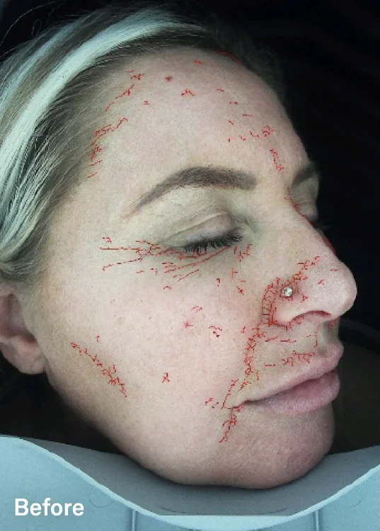 Omnilux Contour Face – klinická fotografie před použitím, boční pohled