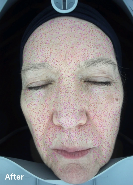 Omnilux Contour Face – klinická fotografie po použití s analytickým mapováním pleti