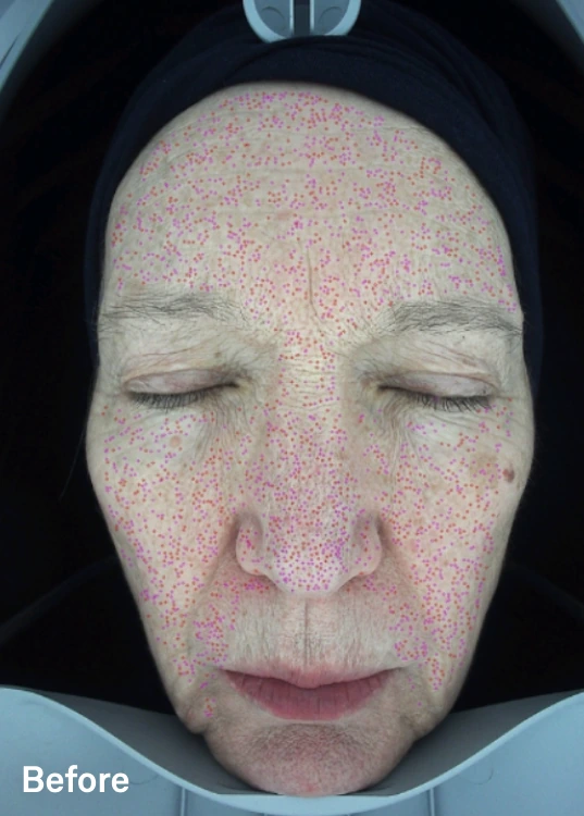 Omnilux Contour Face – klinická fotografie před použitím s analytickým mapováním pleti