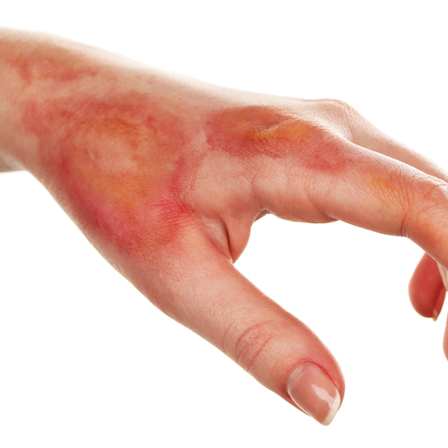 Odřeniny a popáleniny