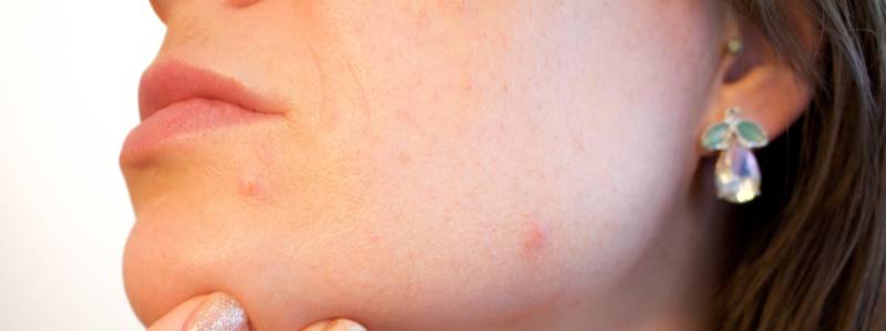 Jak pomáhají probiotika při akné