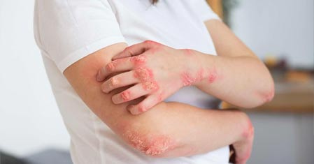 Lupénka – příčiny, příznaky a léčba