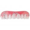 silikonova horna zubna proteza 2