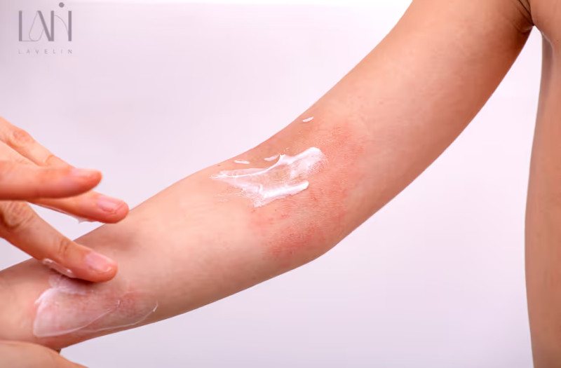 Atopický ekzém: príčiny, príznaky a starostlivosť, ktorá naozaj funguje