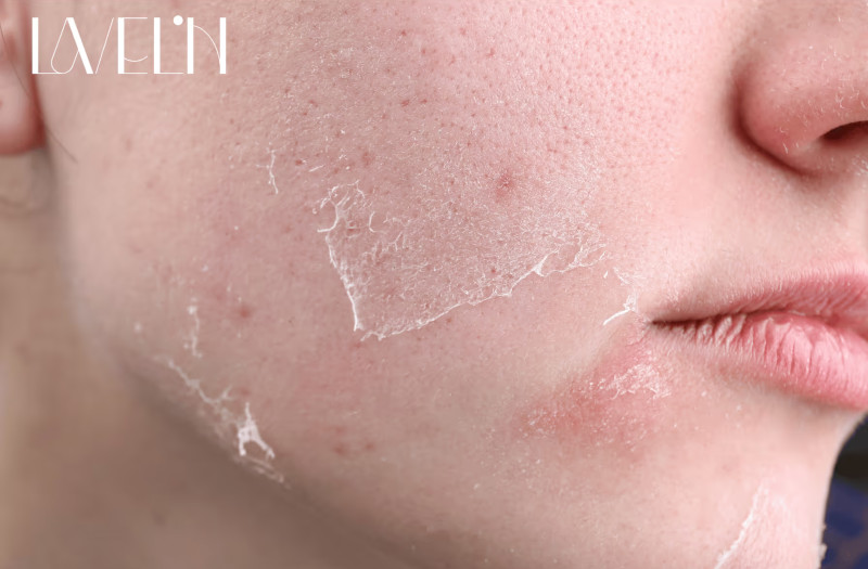 Ako spoznať dehydratovanú pleť a odlíšiť ju od suchej? Tipy, príčiny a kozmetika, ktorá prináša skutočnú hydratáciu.