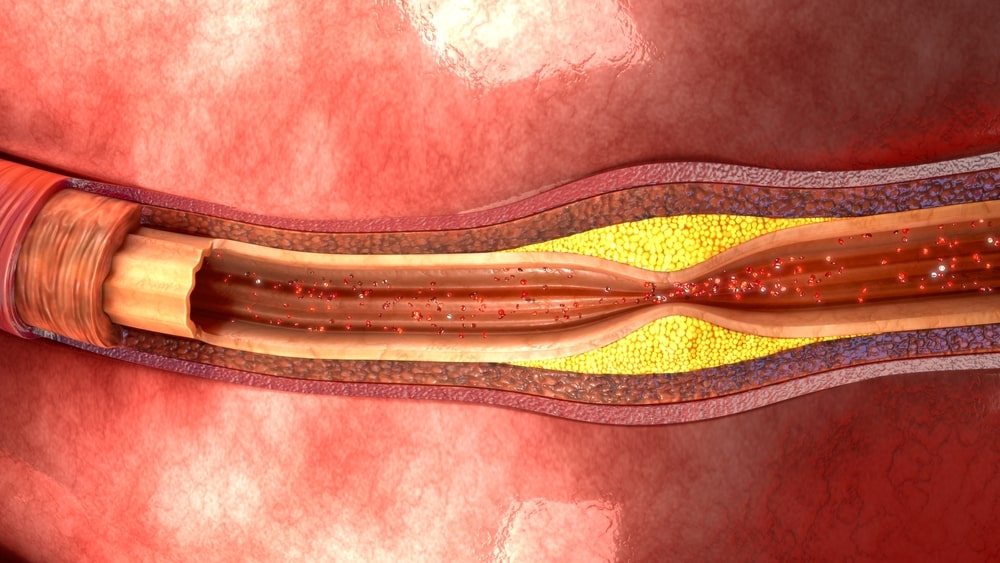 Jak snížit cholesterol?