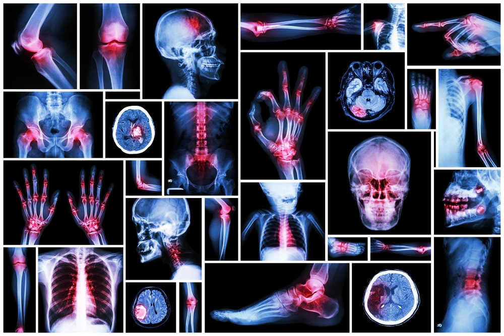 Jde se zbavit osteoporózy nebo artrózy? – 2. část