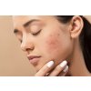 Antiblemish