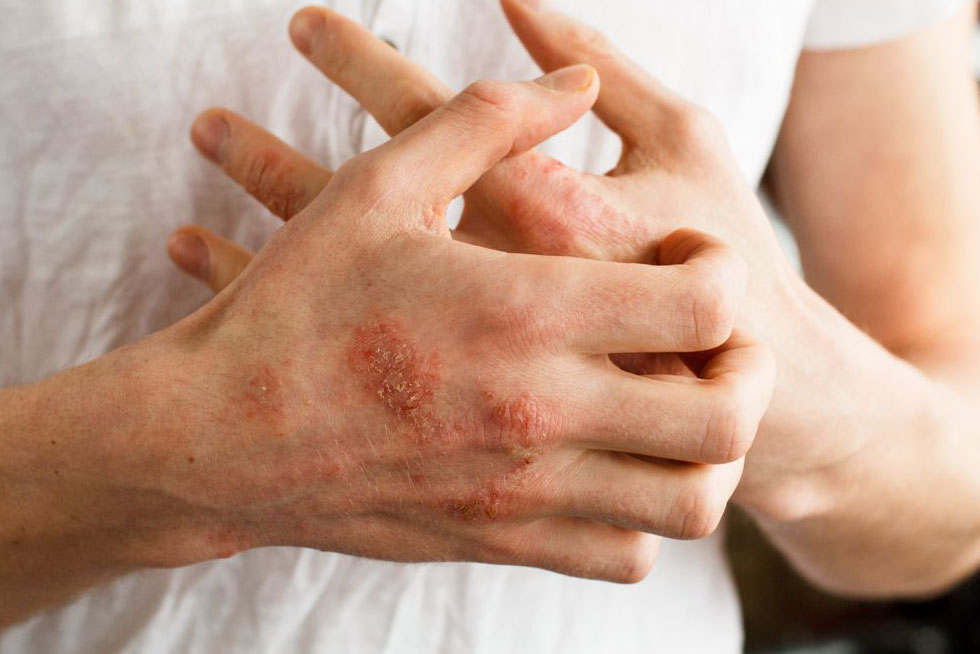 Help with psoriasis