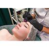 derma roller 5