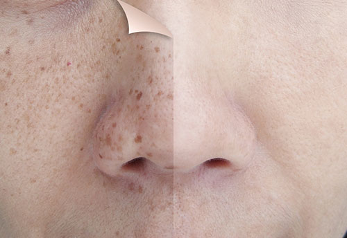 Beat-Those-Dark-Spots-How-to-Prevent-and-Treat-Skin-Pigmentation