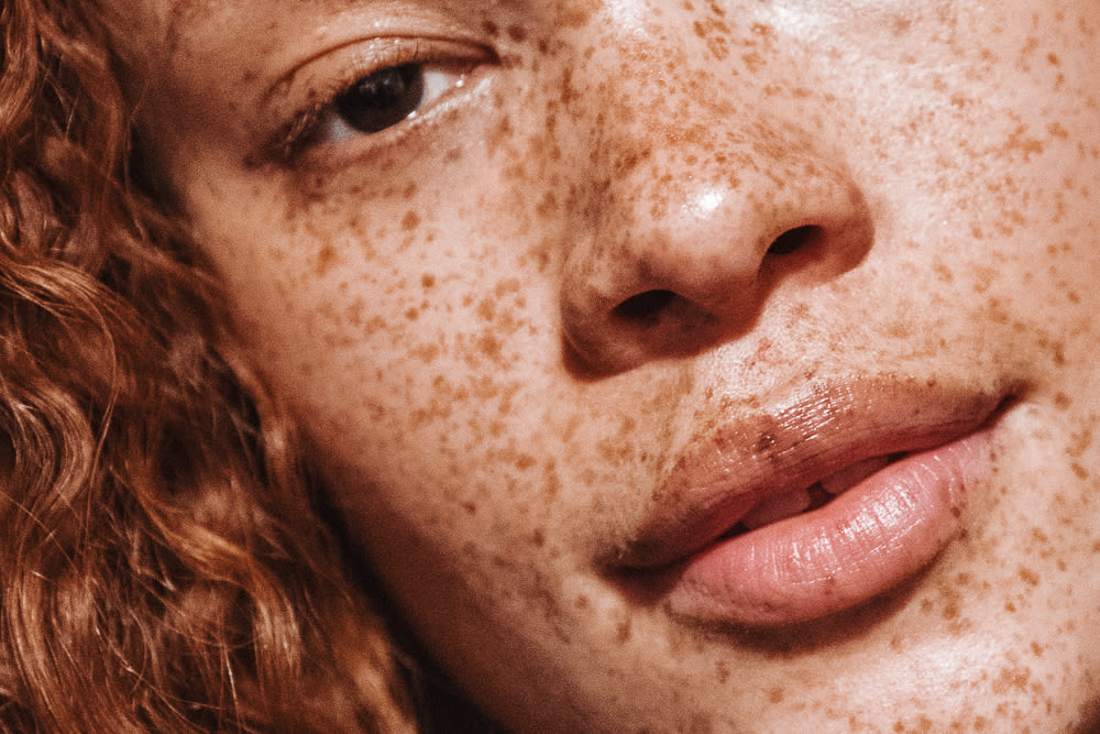 freckles-1