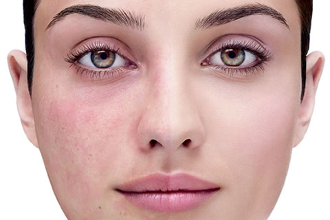 rosacea