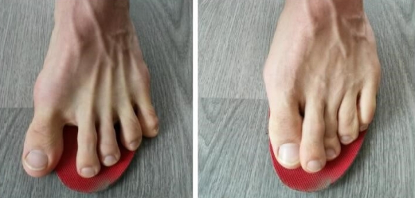 Prsty nohy, vbočený palec v botě