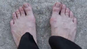 Hallux valgus, vbočený palec, deformované nohy