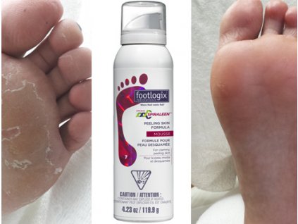 Footlogix Peeling Skin Formula pěna pro loupající se pokožku (7)