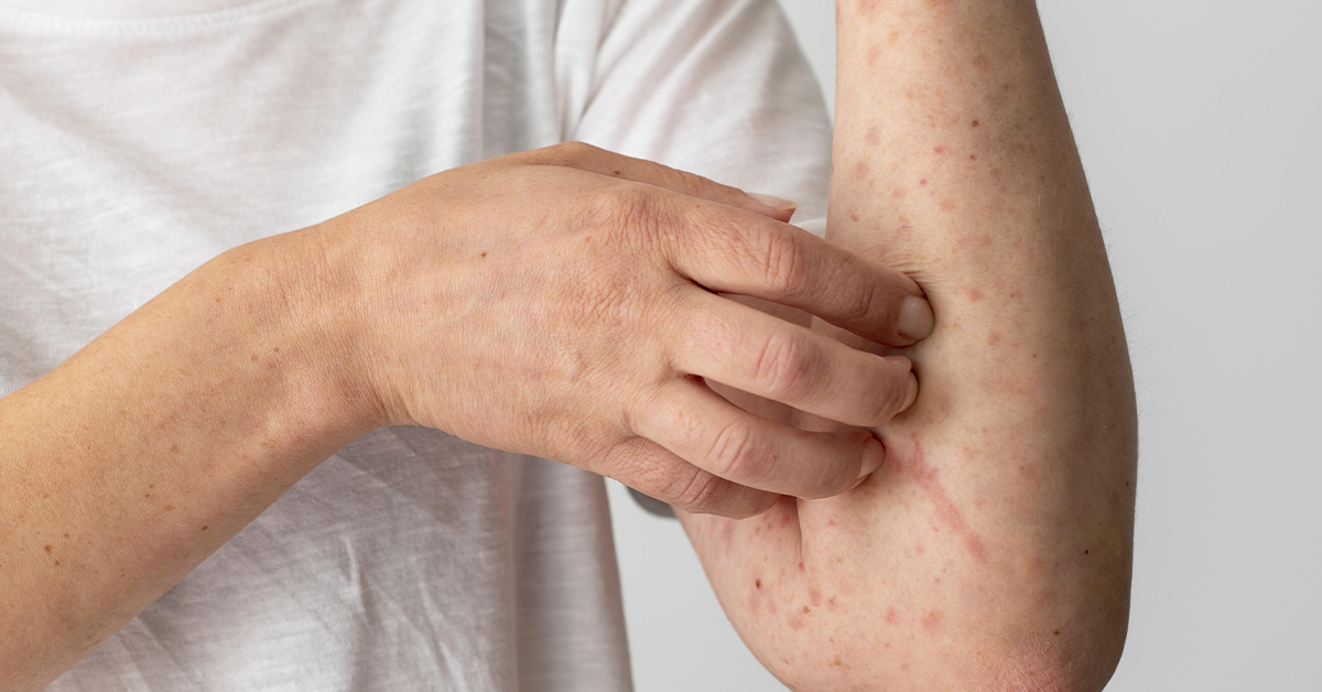 Svědění při ekzému: 5 tipů, jak mu předejít