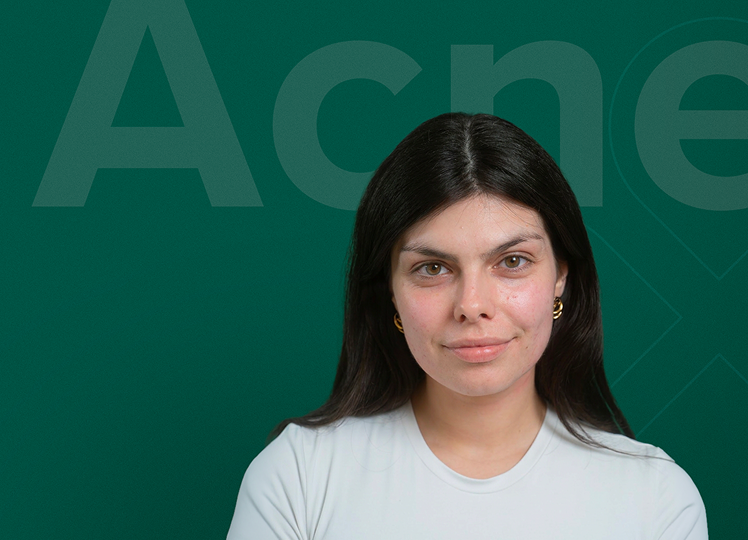 Akné rutina s LOBEY