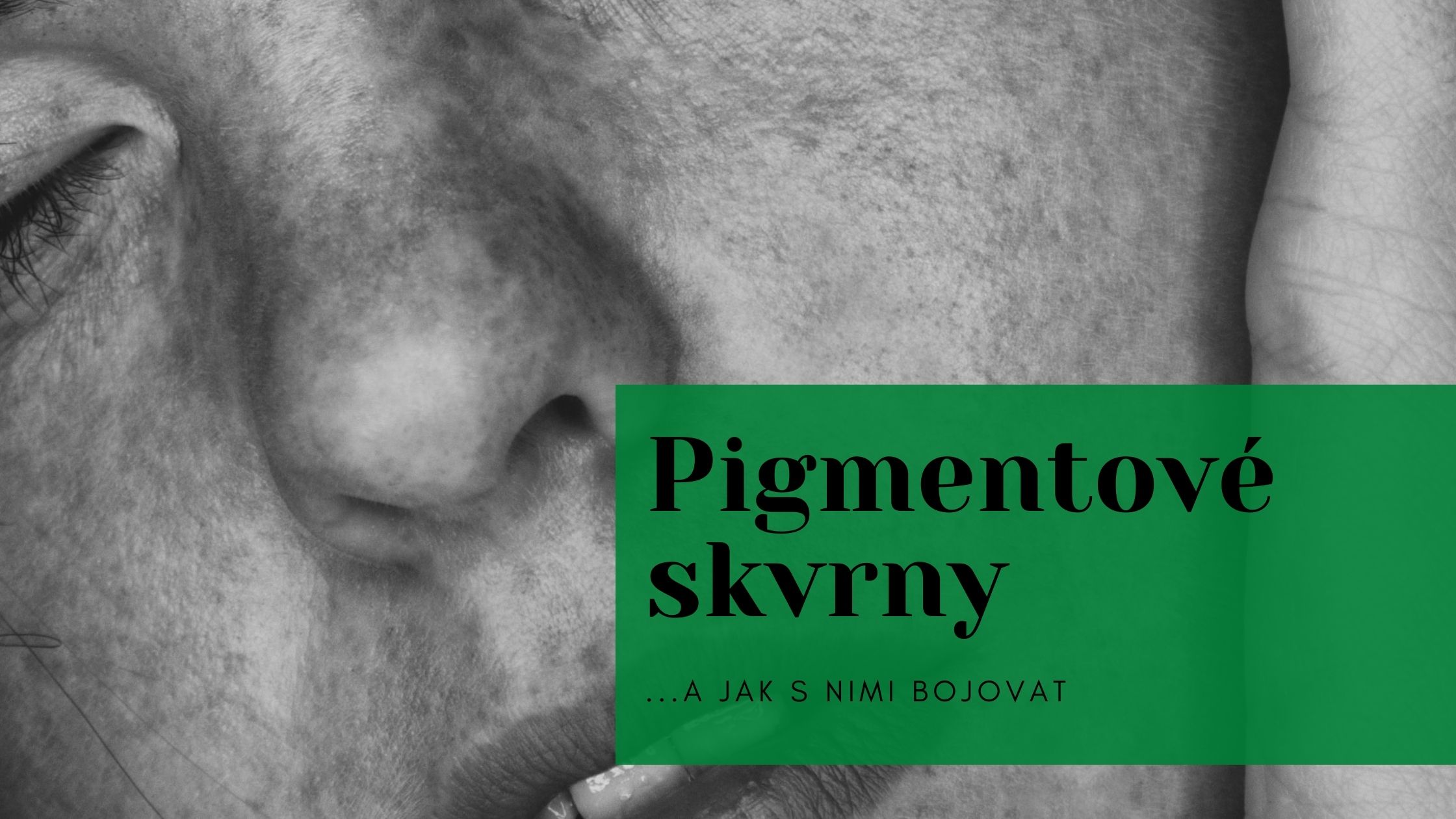 Vše co musíte vědět o pigmentových skvrnách