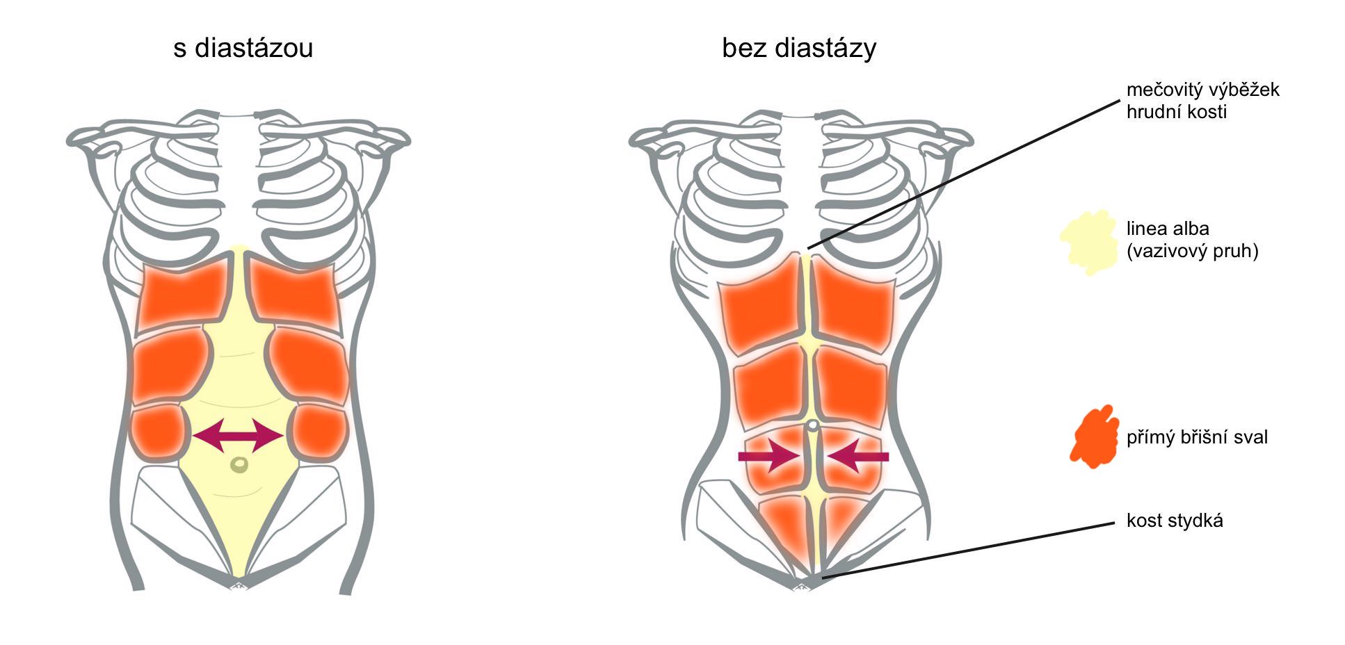 Diastáza břišních svalů