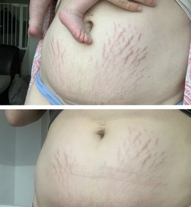 Naydaya Organics Balzám na jizvy a strie výsledky_3