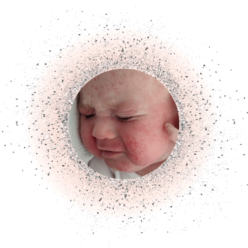 TSW - úleva steroidnímu ekzému