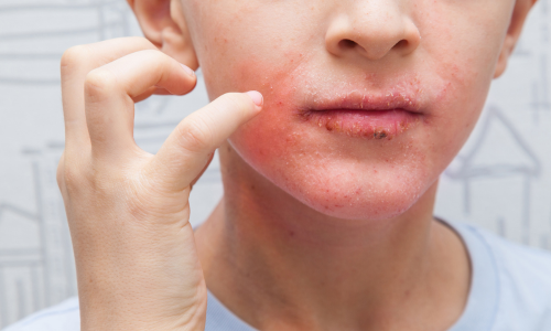 6 tipů jak na svědění při ekzému