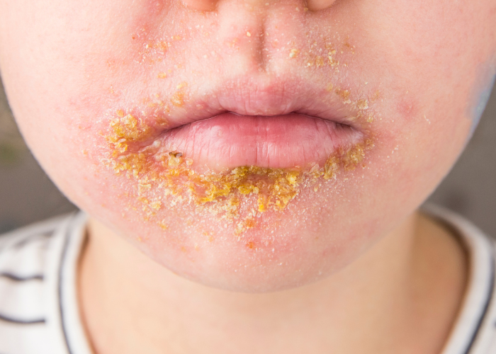 Jak poznám, co není už jen ekzém?