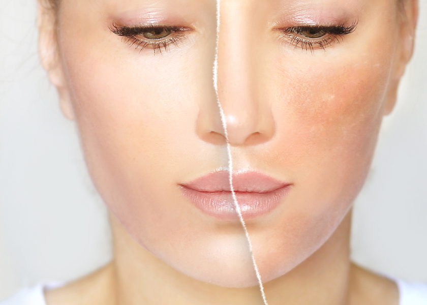 5 aktivních látek, které vaše pleť v chladném počasí potřebuje