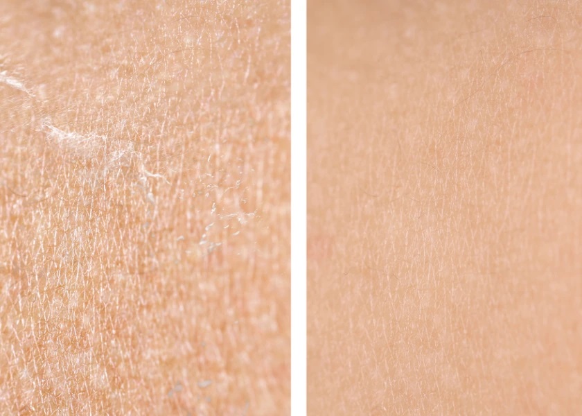 Suchá nebo dehydratovaná pleť? Naučte se poznat rozdíl a správně ji ošetřit