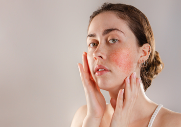 Rosacea (růžovka) a jak na ni