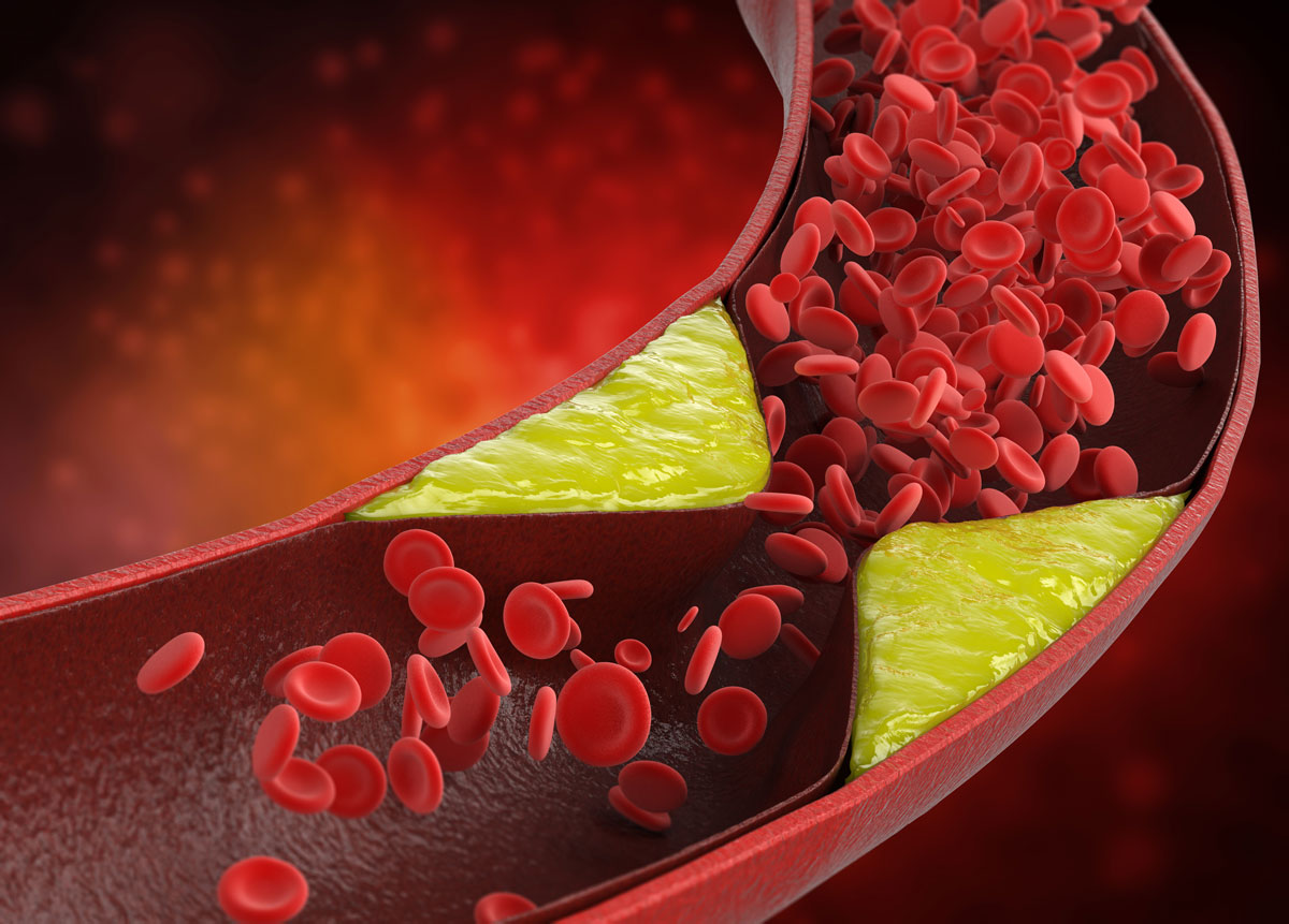 Ako znížiť cholesterol? Rady, tipy a návody!