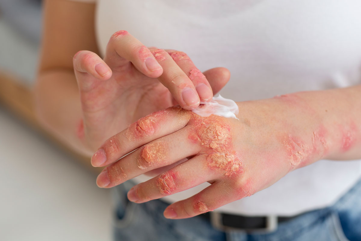 psoriaza-liečba
