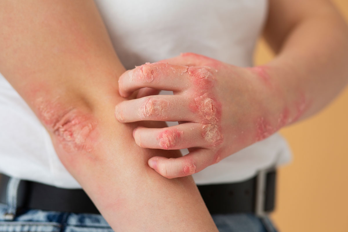 psoriaza