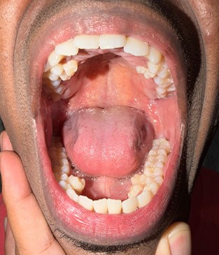 Jaký je rekord v počtu zubů u člověka?