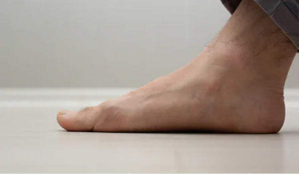 Plochá noha: Největší mýty a fakta, které potřebujete znát