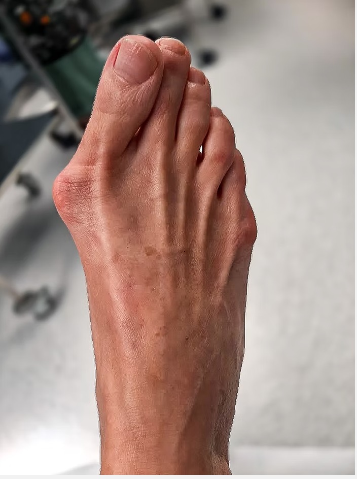 Hallux valgus = vbočený palec: příčiny vzniku, léčba, korektory, výběr obuvi