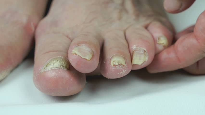 onychomycosis