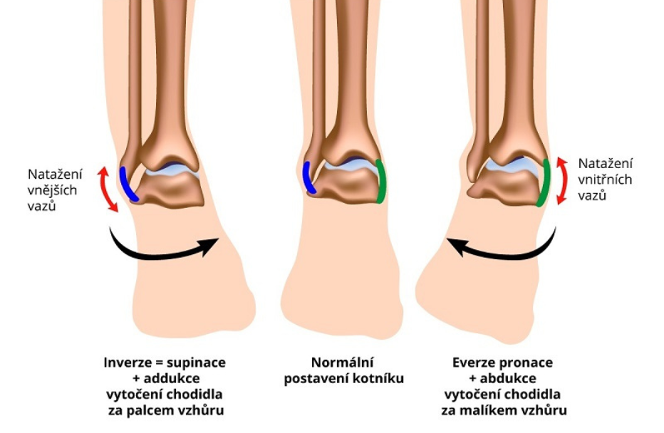Výron kotníku – první pomoc, léčba a prevence [3 cviky] - MedikoBio