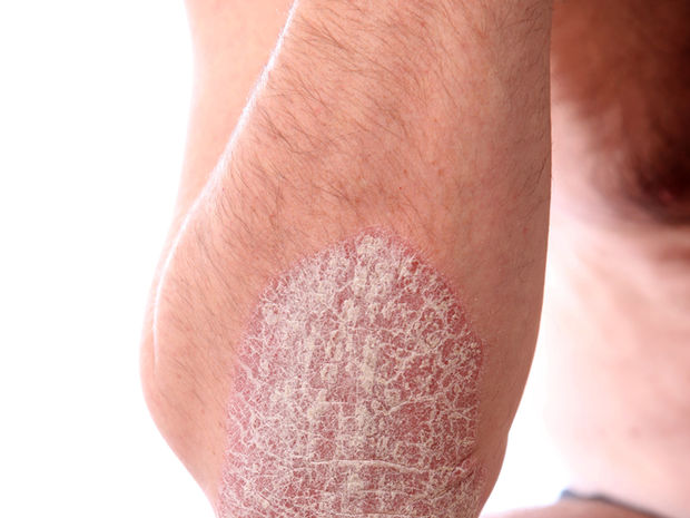 Psoriáza a biolampa